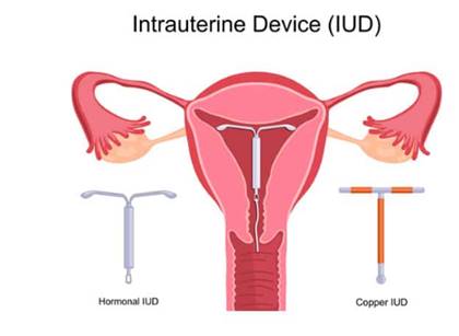 Intrauterine-device