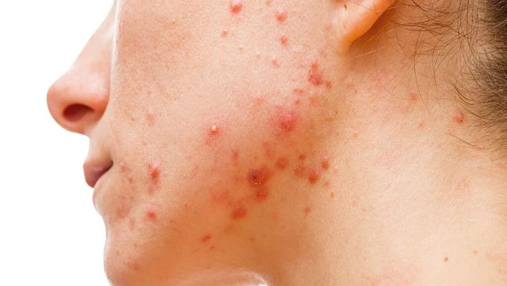 Midland-Health-Acne -awareness-Month-Your-Guide-To-Acne-and-Acne Treatments