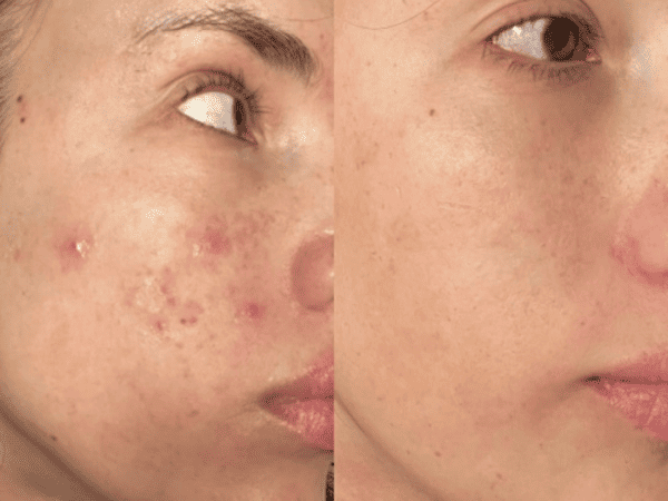 fractional resurfacing