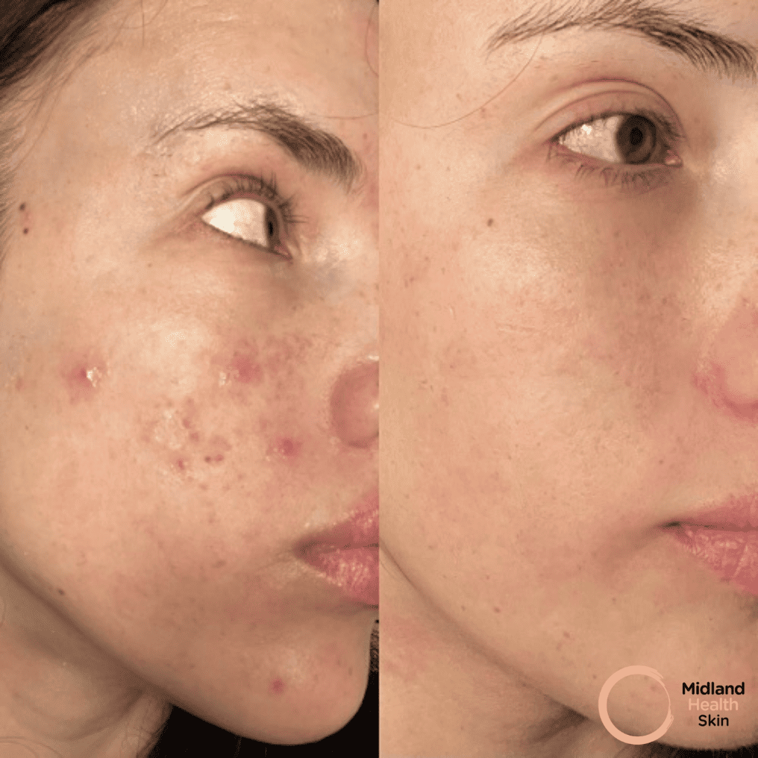IPL Laser Treatment For Active Acne Rosacea Birmingham Midland Health
