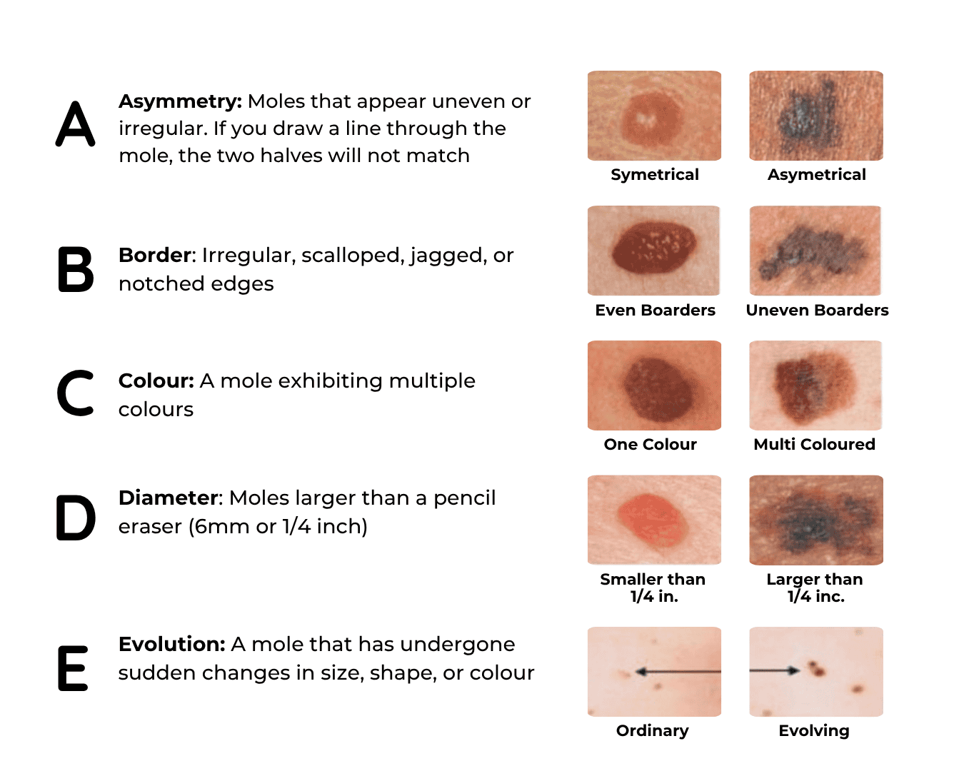 Your Summer Skin Guide: Sunscreen, Skin Health and Spotting Melanoma ...